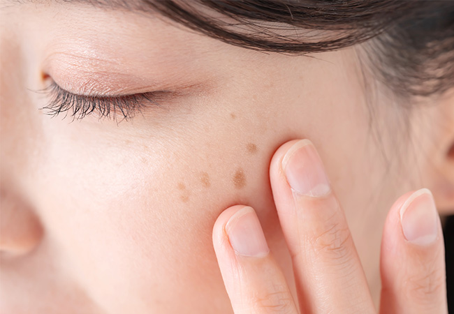 しみレーザー治療